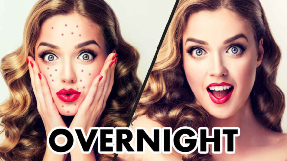 How To Remove Acne Overnight - 5 Home Remedies